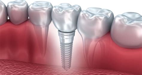 Are Dental Implants Painful How Long Do They Take To Heal