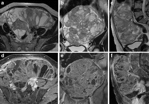 Mr Imaging Of Ovarian Masses Classification And Differential Diagnosis