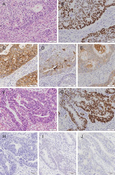 Histology And Immunohistochemical Staining Of Adenocarcinoma With