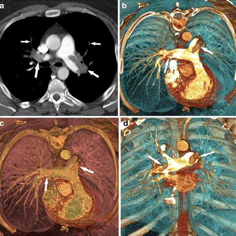 Dual Energy Ct Lung Perfusion Imaging And Lung Vessels Application In A