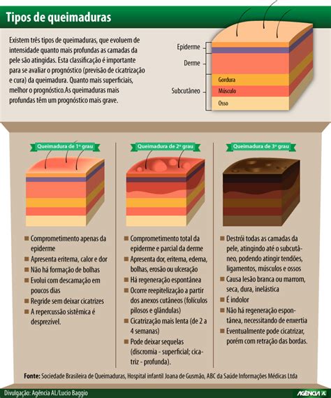 Agência Alesc Tipos De Queimaduras