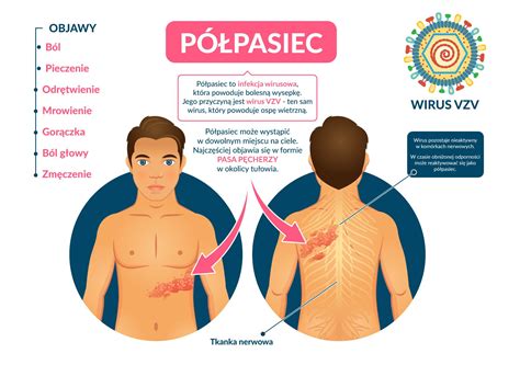 P Pasiec Objawy Leczenie Jak Boli P Pasiec Czy Jest Zara Liwy