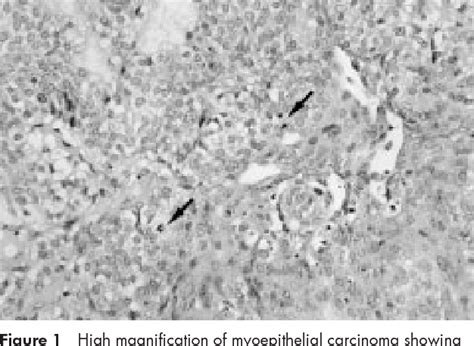 Figure From A Case Of Myoepithelial Carcinoma Displaying Biallelic