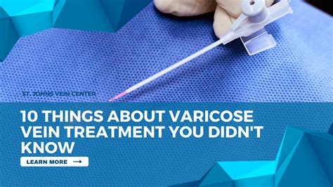 10 Things About Varicose Vein Treatment You Didnt Know St Johns Vein Center