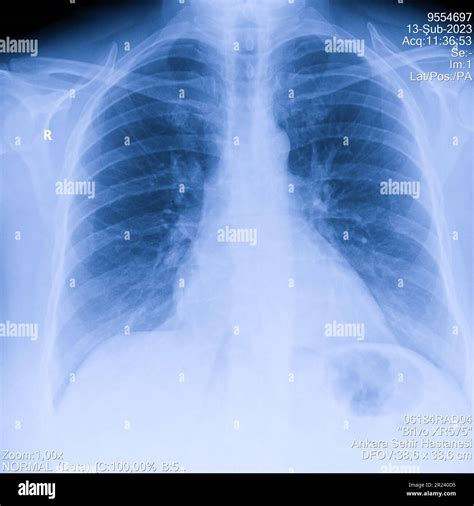 Human thorax x-ray for lungs examination, PA up right. Cancer infected ...