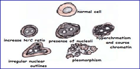 Cytological features of malignancy | Download Scientific Diagram