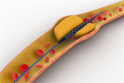 Coronary Stent Placement - LAS VEGAS CARDIOLOGY