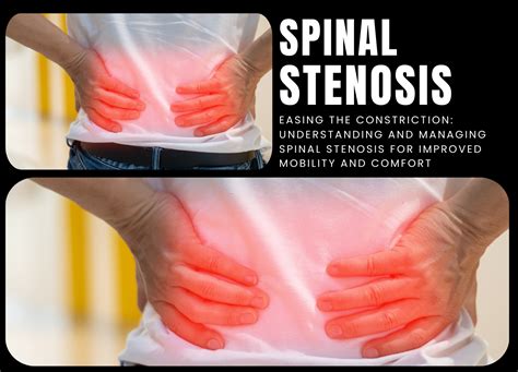 Spinal Stenosis Causes Symptoms And Treatment Boundless Home Health