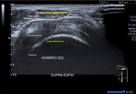 Rotura De Tend N Supraespinoso Tipos Y Semiolog A Ecograf A F Cil