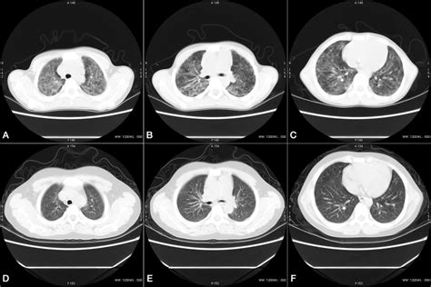 Comparison Of Chest Hrct Images Before Nov 09 2018 A C And After Download Scientific