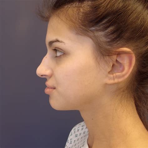 Galerie Prom N Rhinoplastika Klinika Esth Praha