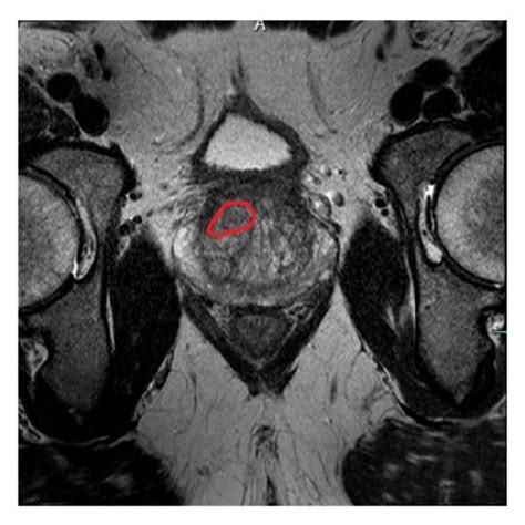 Multiparametric Mri Evaluation And Mri Trus Fusion Biopsy In Patient Download Scientific