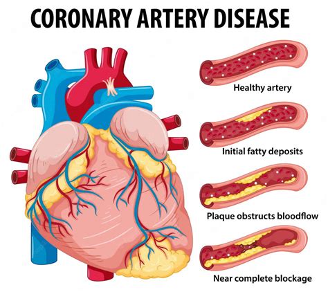 Coronary Artery Disease Symptoms