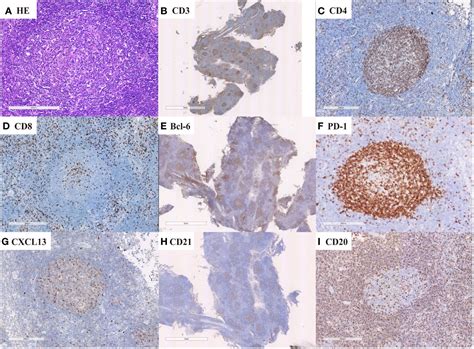 Frontiers Clinicopathologic Analysis Of Nodal T Follicular Helper