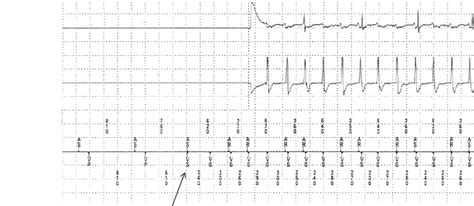 Intracardiac Electrograms Top Atrial Electrogram Center Ventricular