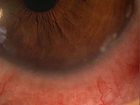 Staphylococcal Marginal Keratitis