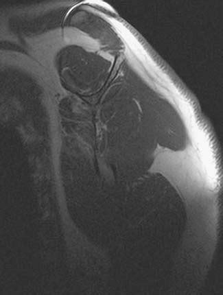 Sagittal T1 Weighted Spin Echo Image After Total Shoulder Arthroplasty