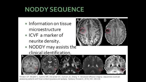 Fcd Focal Cortycal Dysplasia Youtube