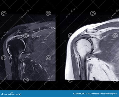 Magnetic Resonance Imaging Or Mri Of Shoulder Joint Coronal T Fs And