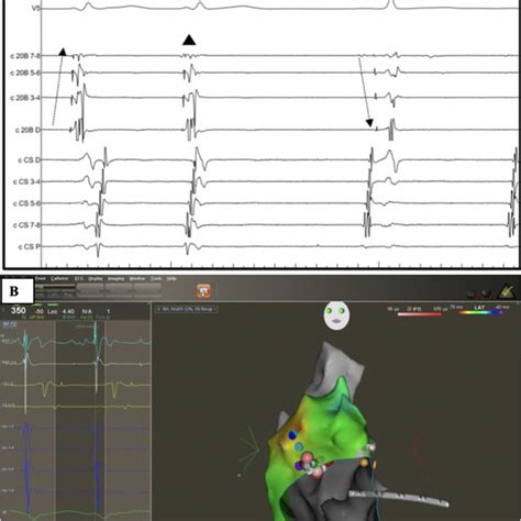 Surface Ecg Electrocardiogram And Intracardiac Egms Electrograms