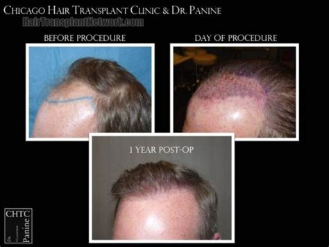 Dr Vladimir Panine Hair Transplant Procedure Before And After Result Photos With 3403 Grafts