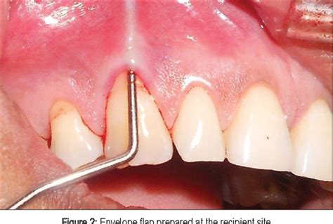 Table From Root Coverage Of A Wide Anterior Mucogingival Defect With