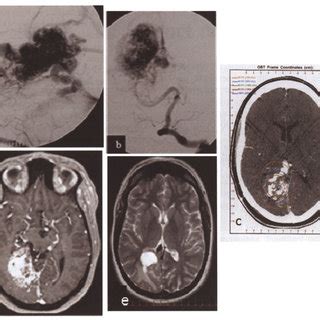 Case 1 DSA Of Lateral A And Anteroposterior B Left VA Vertebral