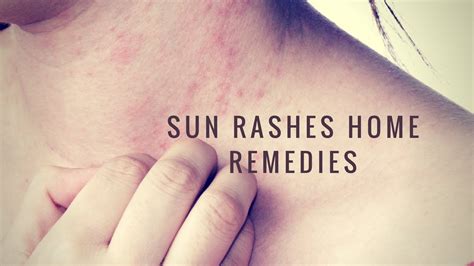 Home Remedies For Sunburn Sun Blisters And Rashes Youtube