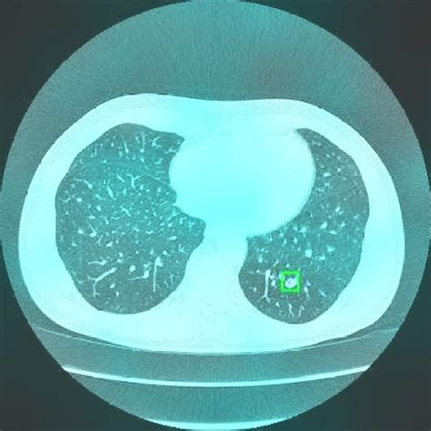 Lung Cancer NormAug Training Instance Segmentation Dataset V1 2023 07