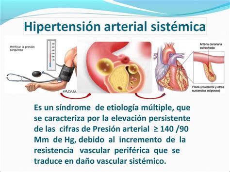 Hipertensi N Arterial Sist Mica Ppt