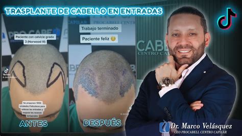 Trasplante De Cabello En Entradas Dr Marco Vel Squez Procabell