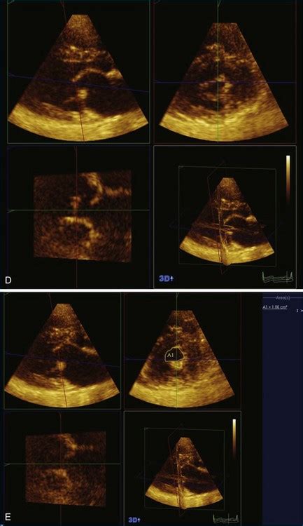 Mitral Stenosis Radiology Key