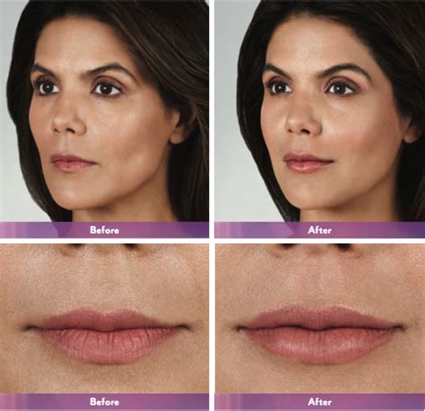 Juvederm Volbella In Grand Rapids Novi Urban You Med Spa