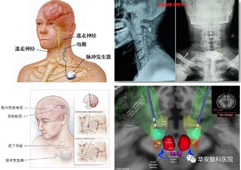 安徽省内成立昏迷病人促醒中心！“植物人”唤醒不是梦 每日头条