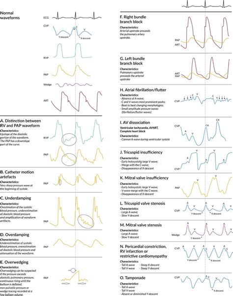 Nephropocus On Twitter Pulmonary Artery Catheter Pressure Waveform