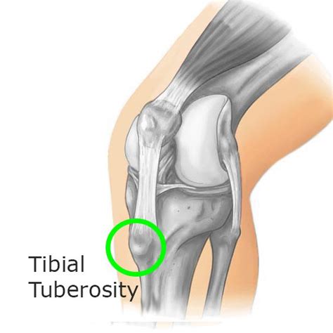 Osgood Schlatter Disease Prof Nicola Portinaro Orthopedic Suregon