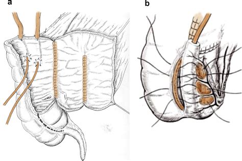 Continent Catheterizable Pouches For Urinary Diversion European