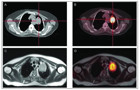 Classical Papillary Thyroid Cancer In A 45 Year Old Man 18 F Fdg Pet Ct