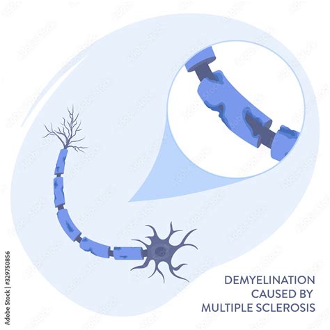 Demyelination Of Neuron Shealth Under Microscope Loss Of Nerve Cell