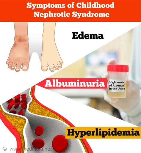 Childhood Nephrotic Syndrome Causes Risk Factors Symptoms