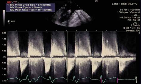 Transjugular Transcatheter Mitral Valve Repair With Mitraclip