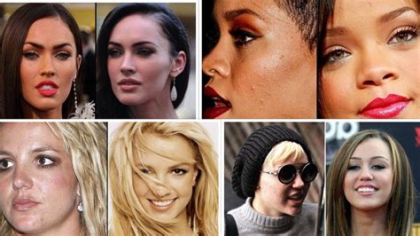 Celebrities With Acne Scars