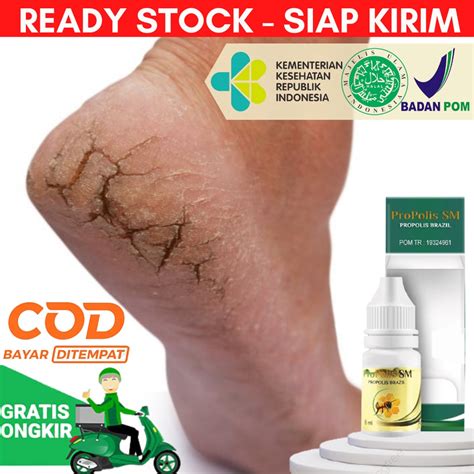 Jual COD Obat Tetes Kaki Pecah Dan Kering Kaki Pecah2 Kaki Pecah