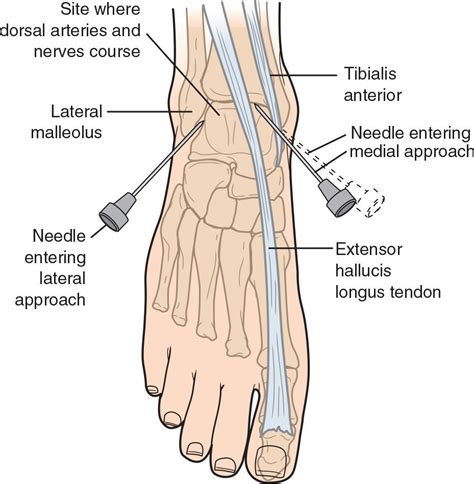 Ankle Arthrocentesis | Anesthesia Key