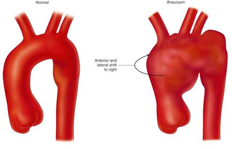 Aortic Arch Aneurysms - Clinical Tree