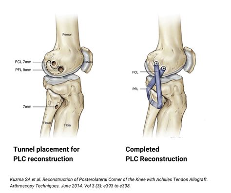 Posterolateral Corner Plc Injuries Dr Edward S Chang Md