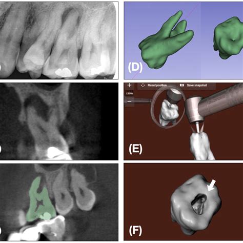 A Case Of Virtual 3d Tooth 26 Assess Cavity Preparation In Clinical