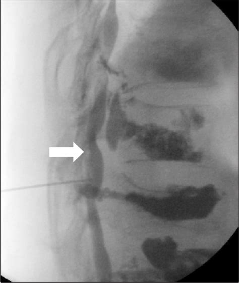 Epidural Steroid Injection By Interlaminar Approach C Arm Fluoroscopic