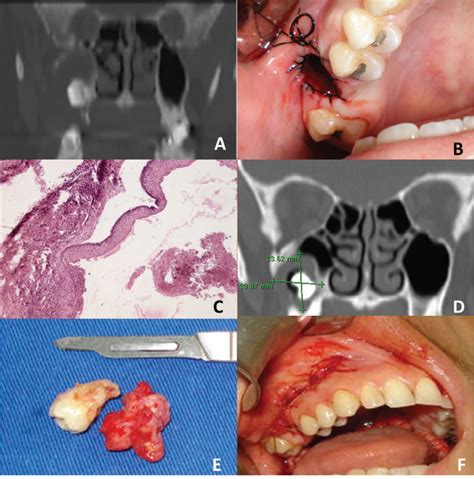 Keratocystic Odontogenic Tumor In The Maxillary Sinus A Rare