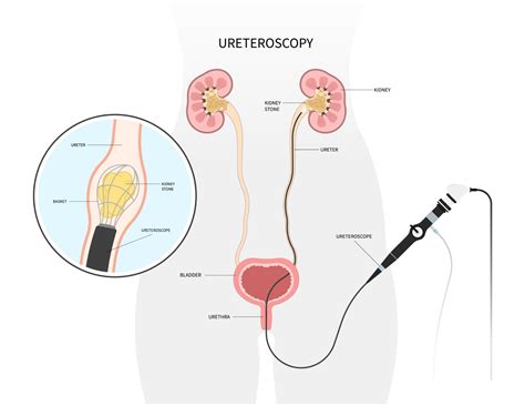 Ureteroscopic Lithotripsy Ursl Procedure Recovery Surgery Cost